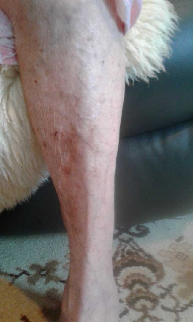 skin tear after treatment right leg