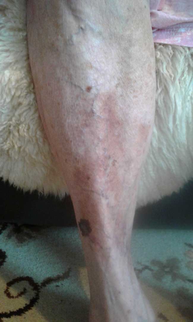 Skin Tear Treatment left leg