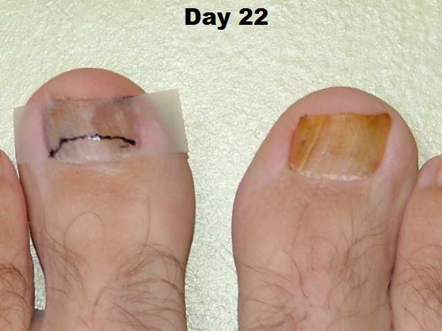 Derm Dx: Thickened toenails - Clinical Advisor